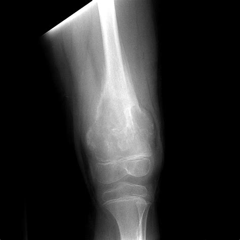 Osteosarcoma - distal femur with pathological fracture | Image | Radiopaedia.org