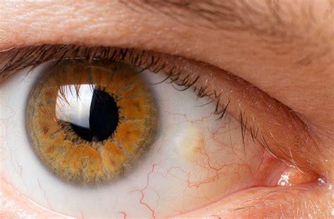 Pinguecula vs. Pterygium: What’s the Difference? | Calgary