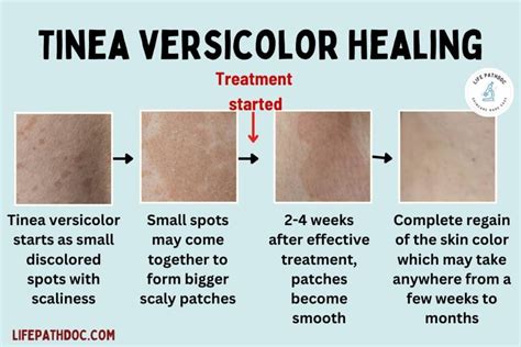 Tinea Versicolor: Healing Stages, Pictures, and Treatment