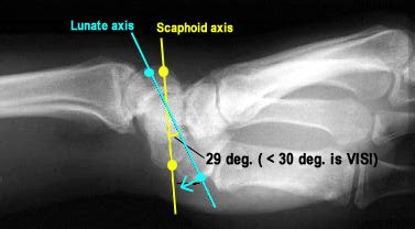 Lunotriquetral Ligament Injury & VISI - Hand - Orthobullets