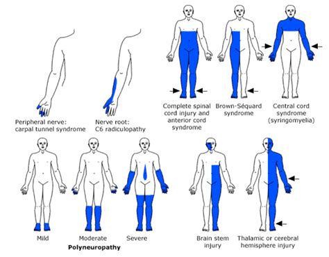 Neuromuscular Weakness | RECAPEM