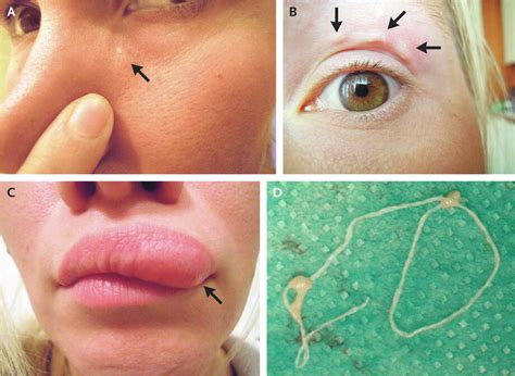 Moving bumps on woman's face turn out to be migrating worm - SFGate