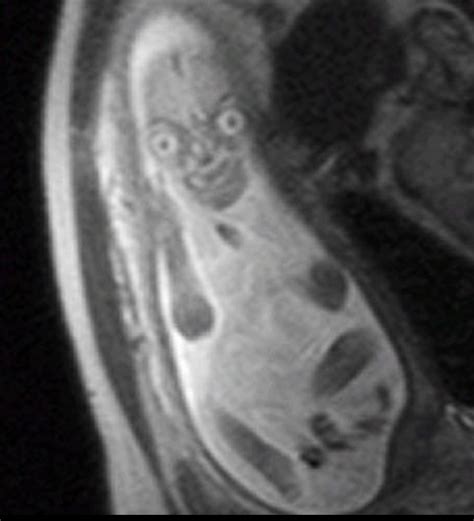 Baby in stomach during MRI : r/MakeMeSuffer