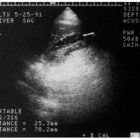 CT scan of the same patient in Fig 3 shows perisplenic and lesser sac ...