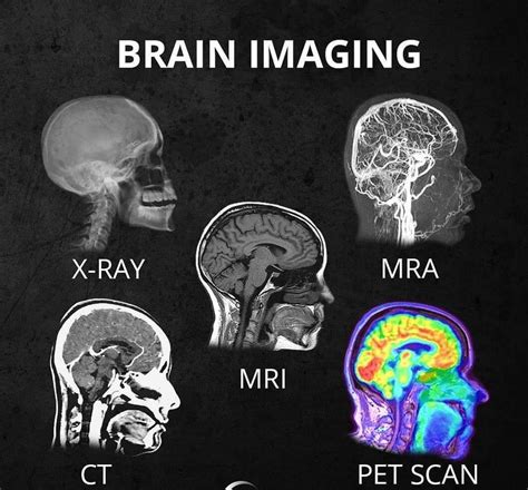 Brain imaging : r/interestingasfuck