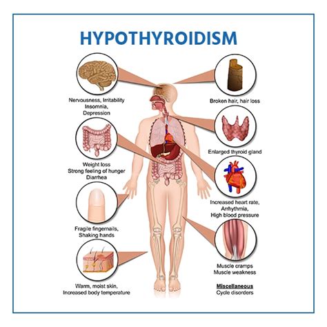 Graves Disease Diagram