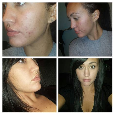 Exactly four weeks on Aczone and Tretinoin. Before and after (Sorry ...