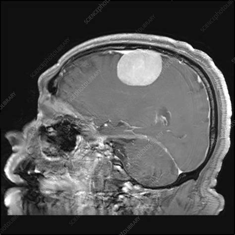 Large Meningioma on MRI - Stock Image - C027/1688 - Science Photo Library