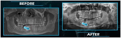 Facial Trauma Surgery - Jaw Correction Surgery