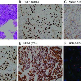 The pathological results of ultrasound-guided liver biopsy. (A) The ...