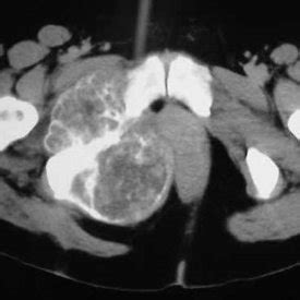 Photo of the internal hemipelvectomy surgery showing the preservation ...