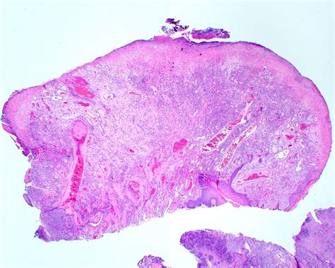 Oral Pyogenic Granuloma Histology