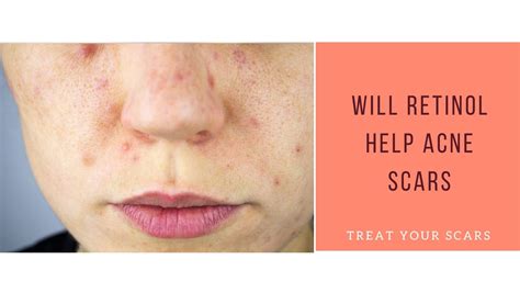 Will Retinol Help Acne Scars - Treat Your Scars