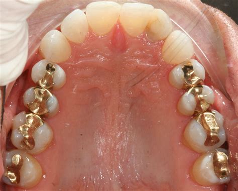 Gold Inlays and Onlays | The Mark Dental Group