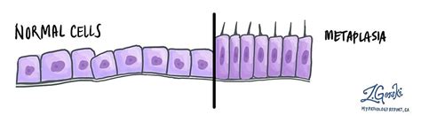 Metaplasia - MyPathologyReport.ca