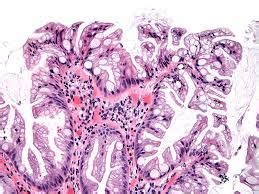 Sessile serrated (polyp) lesion