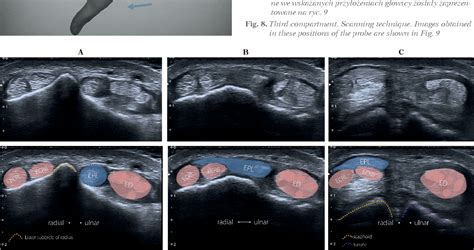 Figure 8 from Wrist ultrasound examination – scanning technique and ultrasound anatomy. Part 1 ...