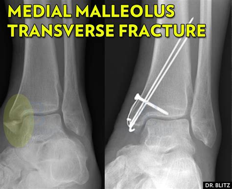 5 Kinds of Medial Malleolus Ankle Fractures