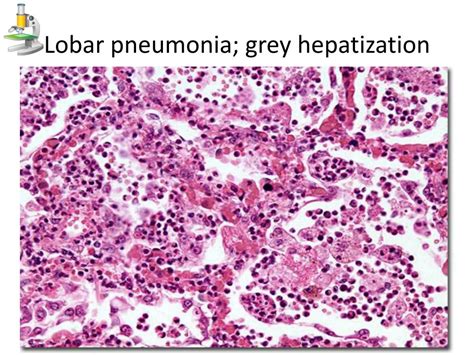 Lobar Pneumonia Histology