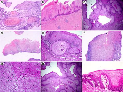 Histomorphology and Molecular Profiling of Well-Differentiated Squamous Cell Carcinoma of the ...