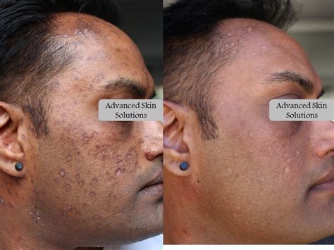 Acne - Advanced Skin Solutions