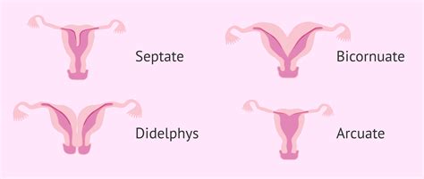 Common uterine malformations