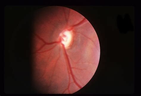 Optic Nerve Hypoplasia - Retina Image Bank