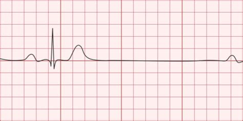 Sinus Bradycardia - Differential Diagnosis of