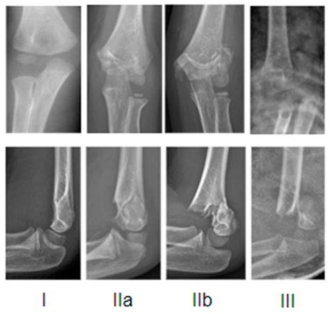 JCM | Free Full-Text | Evaluation of Gartland Classification, Baumann Angle and Anterior Humeral ...