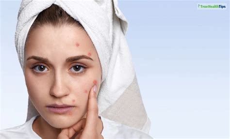 Boil VS Pimple - What Is The Difference? - True Health Tips