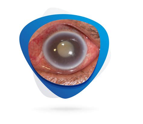 Ocular Surface Disorders - PharmaLegacy | Preclinical Pharmacology CRO