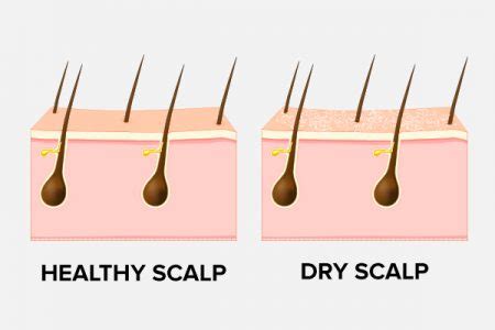 Dry Scalp: Causes, Symptoms, & Treatment - eMediHealth