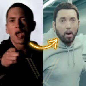 Eminem Beard Transplant – Before and After Transformation