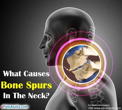 What Causes Bone Spurs in the Neck?