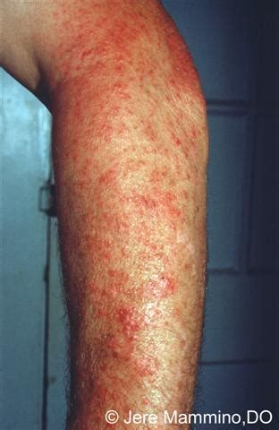 Polymorphous Light Eruption - American Osteopathic College of Dermatology (AOCD)