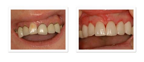 Porcelain Crowns from Winning Smiles Cosmetic Dentistry Team