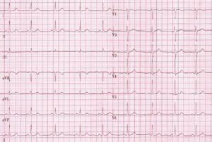 P Wave Morphology - ECGpedia