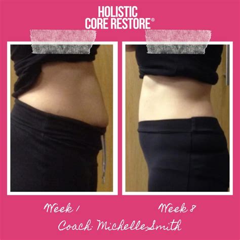 Before & After Diastasis Recti Repair Gallery - Holistic Core Restore