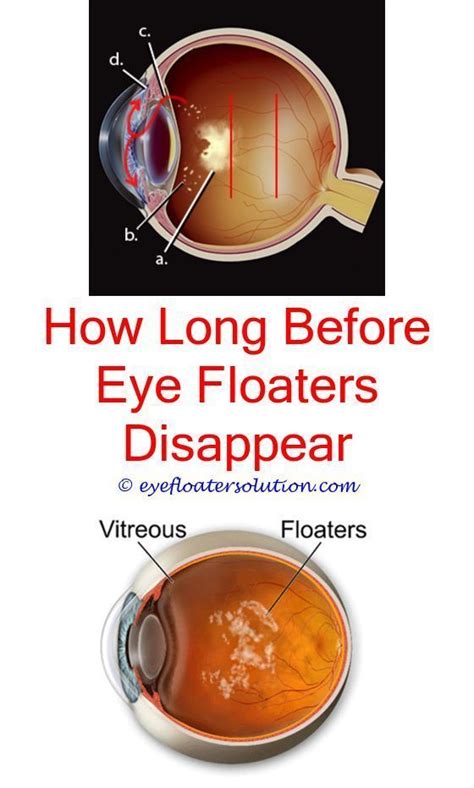 eye floaters caused by dehydration - eye degeneration floaters.symptoms ...