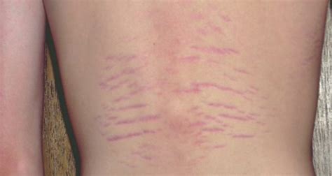 Can i Treat Bartonella Rashes Naturally? Read Here