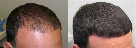 Finasteride Before and After Photos [2023]