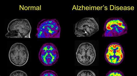 Brain scan gives hope for Alzheimer's disease - ABC listen