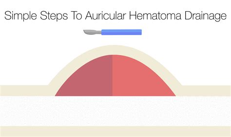 Simple Steps To Auricular Hematoma Drainage — NUEM Blog