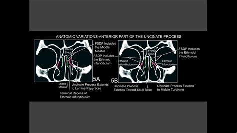 Uncinate process - YouTube