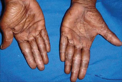 Indian Journal of Dermatology, Venereology and Leprology - Hand and foot syndrome secondary to ...