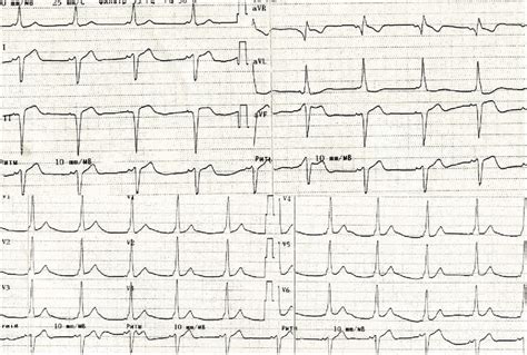 Electrocardiogram with a delta wave. The negative delta wave in ...