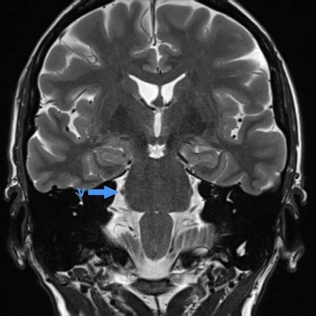 Trigeminal Ganglion Mri