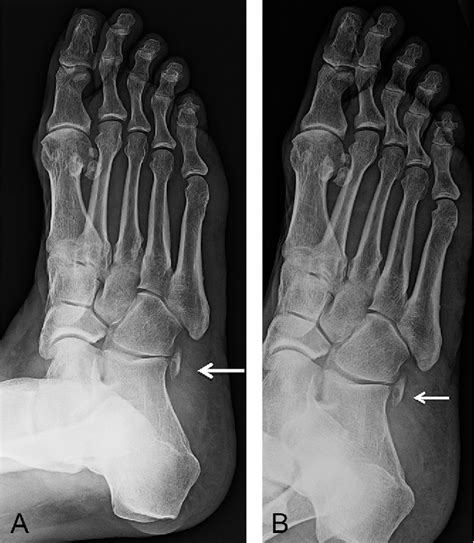 Figure 1 from Progressive retraction of a fractured os peroneum suggesting repetitive injury to ...