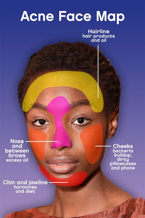 Acne Face Map: Here’s Why You’re Breaking Out | Glamour