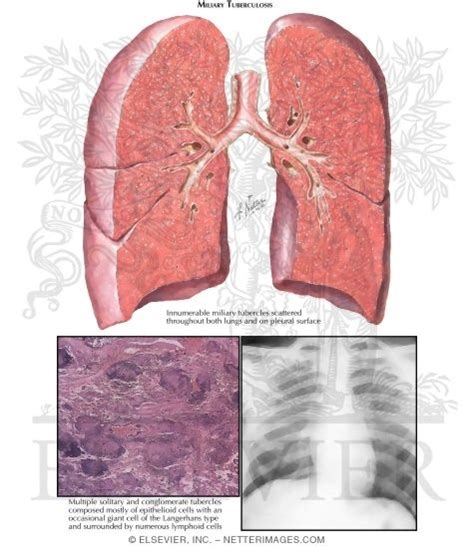 Miliary Tuberculosis